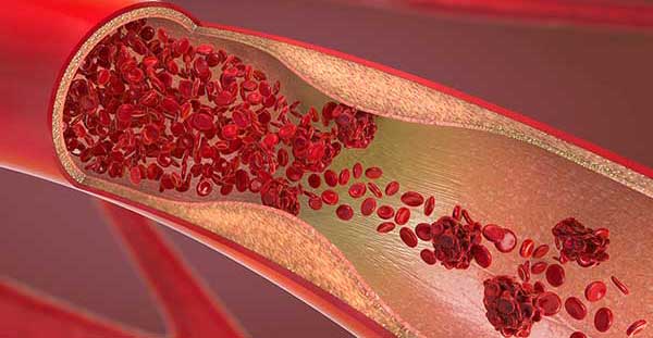 Thrombosis - the presence of D-dimer indicates that the in vivo coagulation system has been activated, forming a thrombus